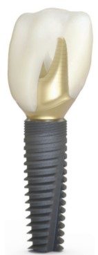 ds implant2